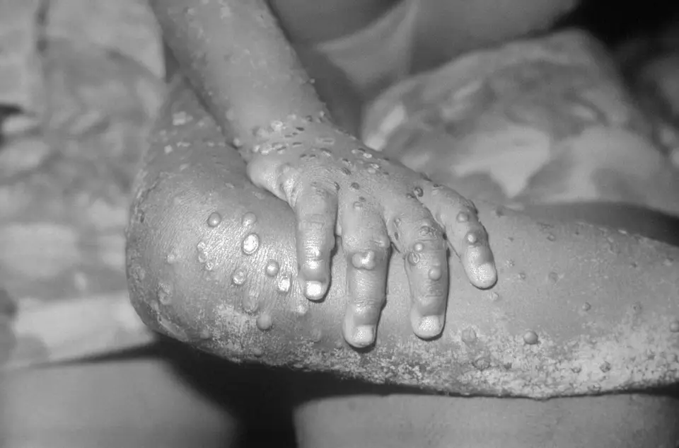 Mpox no Rio: casos sobem e a capital está sem vacina